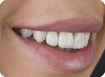 Estética dental